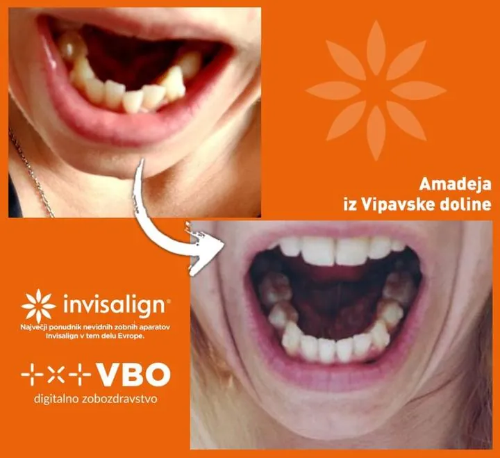 Instagram zgodba — Pacient VBO