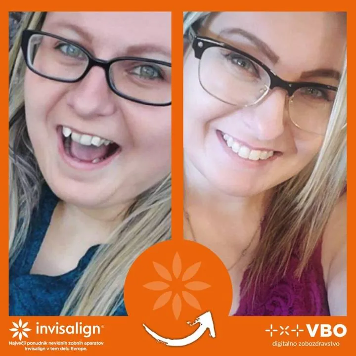 Instagram zgodba — Pacient VBO