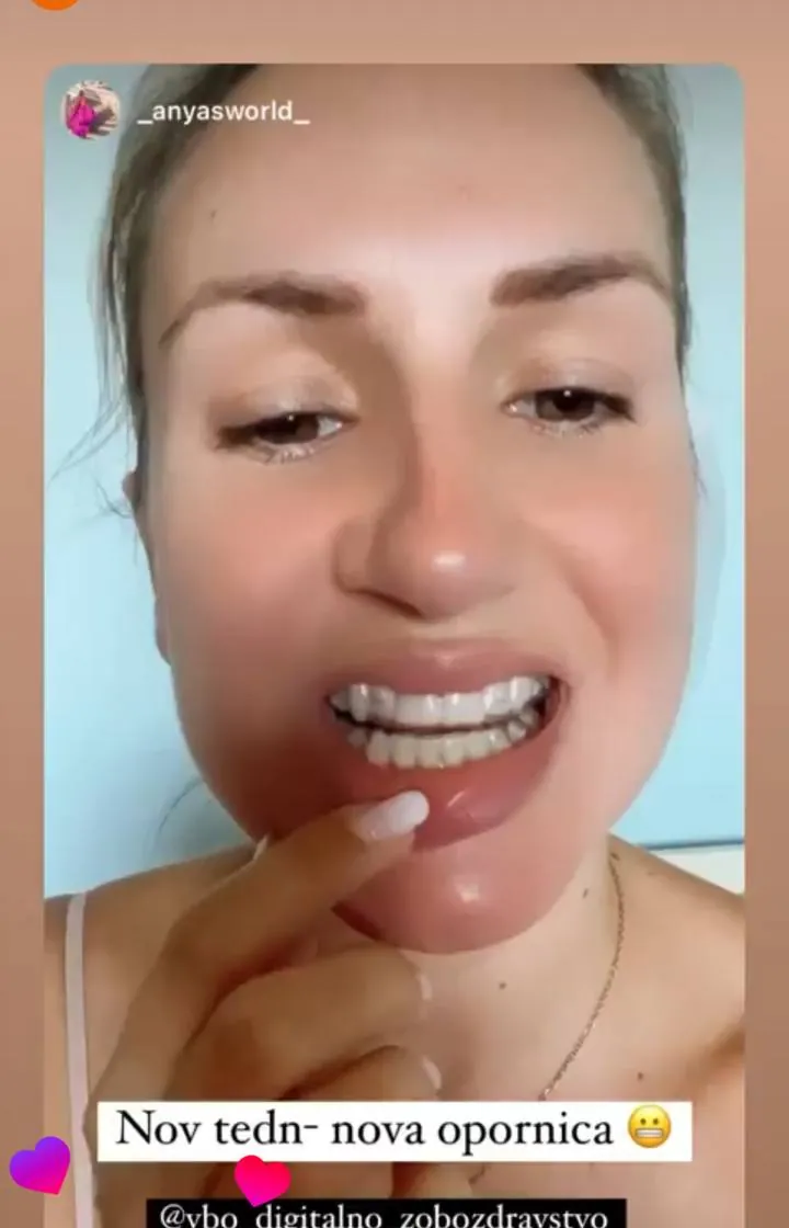 Instagram zgodba pacienta VBO
