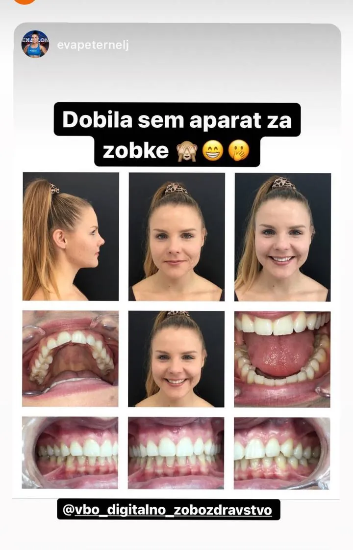 Instagram zgodba pacienta VBO