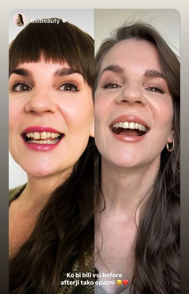 Instagram zgodba pacienta VBO o poravnavi z aparatom Invisalign