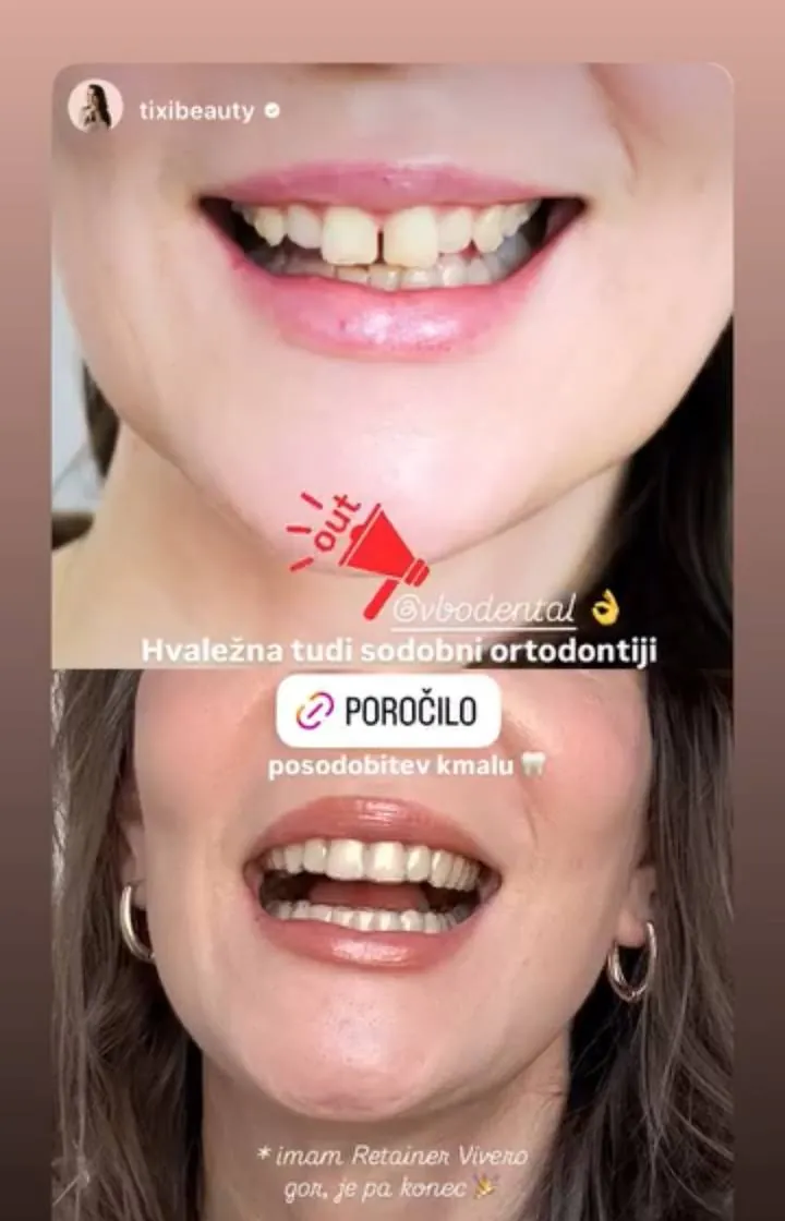 Instagram zgodba pacienta VBO o poravnavi z aparatom Invisalign