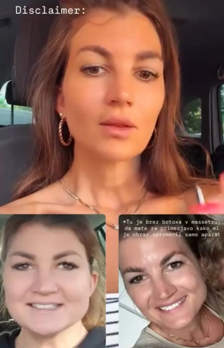 Instagram zgodba pacienta VBO o poravnavi z aparatom Invisalign