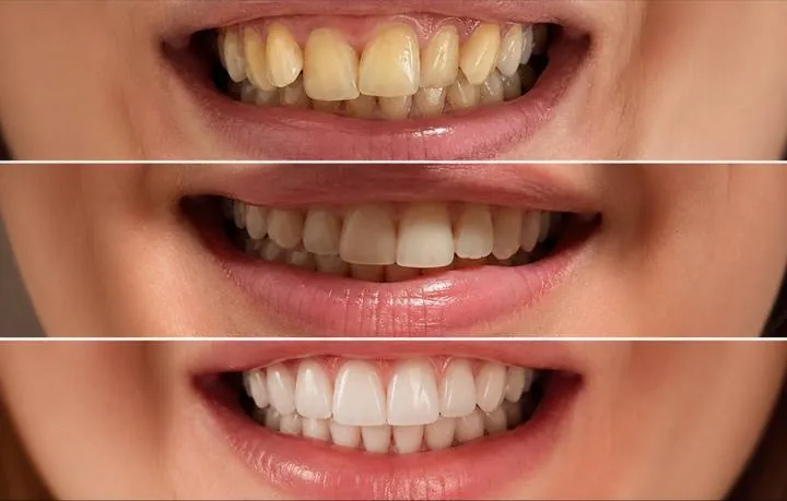 Instagram zgodba pacienta VBO o poravnavi z aparatom Invisalign