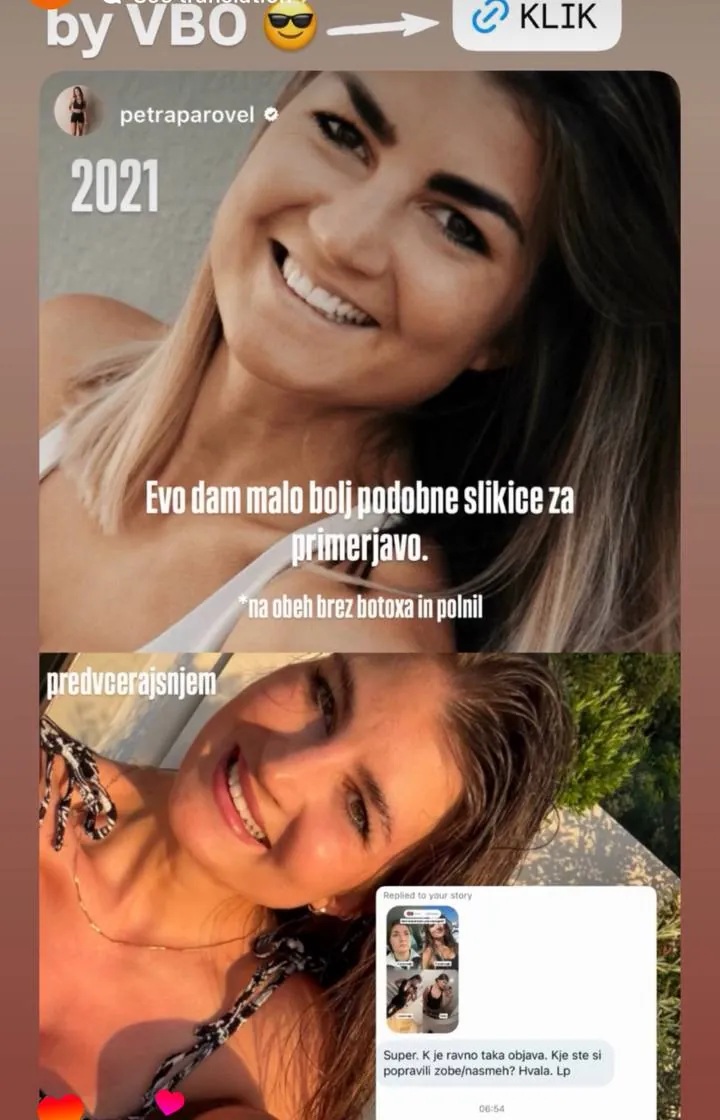Instagram zgodba pacienta VBO o poravnavi z aparatom Invisalign